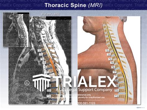 Thoracic Spine (MRI) - TrialQuest Inc.