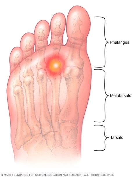 Metatarsalgia or Foot Pain - The Orthobiologic Clinic