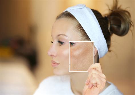 Melasma Prevention & Treatment Guide | Garden City Wellness Spa