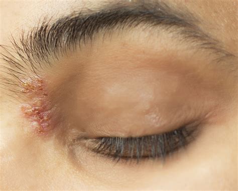 How Shingles Can Affect Your Eyes - Valley Eyecare