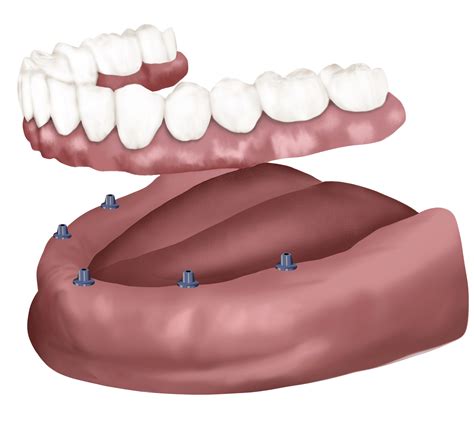 All-on-x | Antoine Dental Center