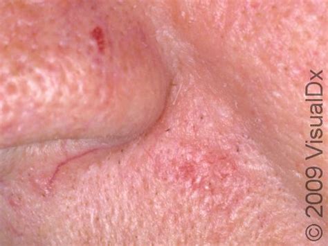 Skin Cancer On Face Early Signs