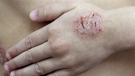 Nummular Eczema vs. Ringworm Guide | National Eczema Association