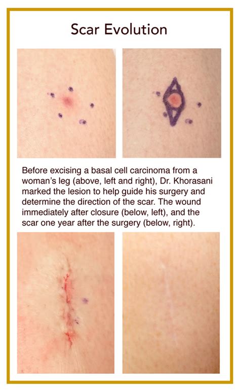 Embrace Your Scars - Rochester Dermatologic Surgery | Surgical ...