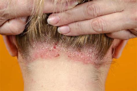 Scabs and Sores on Scalp: 17 Causes, Pictures and Treatment