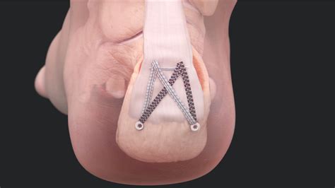 Arthrex - Minimally Invasive FiberTak® Achilles SpeedBridge™ Repair ...