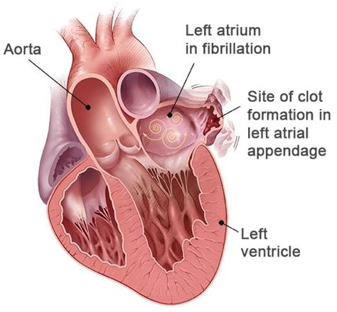 WATCHMAN Device for Atrial Fibrillation | Heart Rhythm Consultants