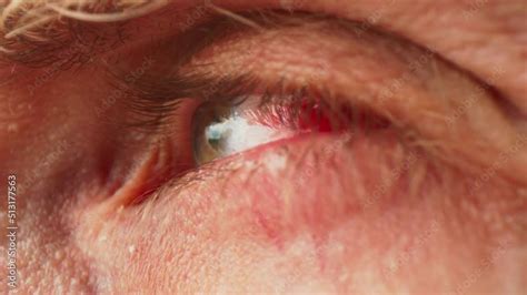 Subconjunctival hemorrhage - hyposphagma. Eye with ruptured blood ...