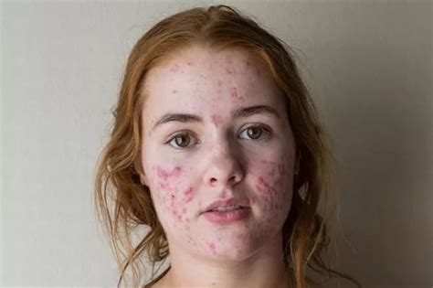 42+ Acne Red Marks On Back Pictures - Just Sharing