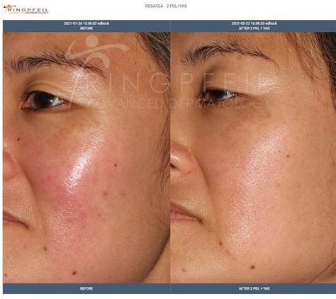 Rosacea Treatment & Medication, Philadelphia | Rosacea Laser Therapy, PA