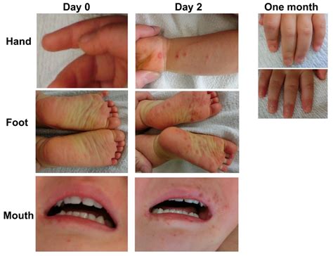 Hand Foot And Mouth Disease Mild Case