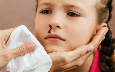 What Causes Nosebleeds in Kids: Ultimate Guide About Childhood ...