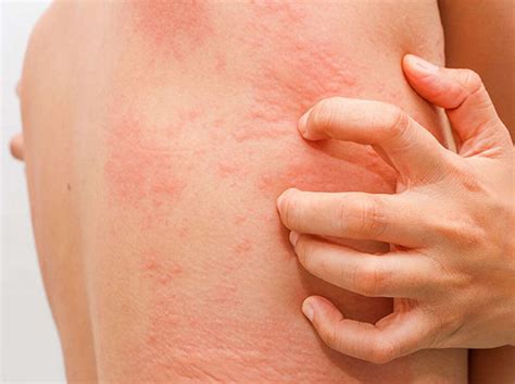 Hives: 10 Symptoms of Hives