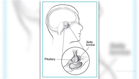 Prolactinoma Surgery and Recovery | Nervous System Disorders and ...