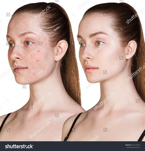 Girl Acne Before After Treatment Stock Photo 544114579 | Shutterstock