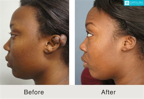 Keloid Removal on Ear - Carolina Facial Plastics