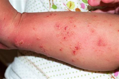 Scabies - myDr.com.au