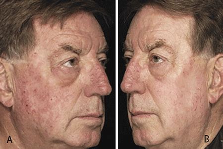 Actinic Keratosis: Diagnosis and treatment | South Nassau Dermatology