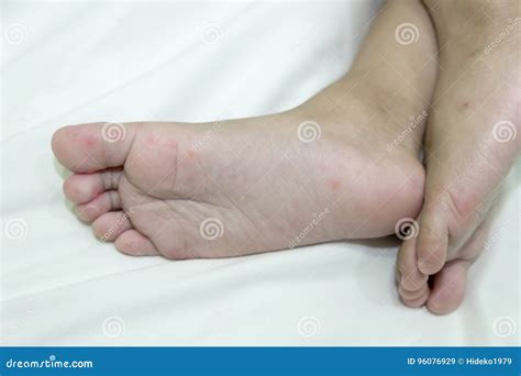 Allergic Rash Skin of Baby`s Right Foot Stock Image - Image of eczema ...