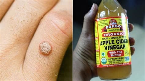 How To Use Apple Cider Vinegar For Genital Warts? - Ostomy Lifestyle