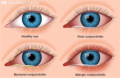 146 Images Viral Conjunctivitis For FREE - MyWeb