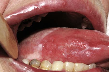 Squamous Cell Carcinoma Tongue