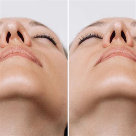 Nasal Reconstruction - Coastline Plastic Surgery