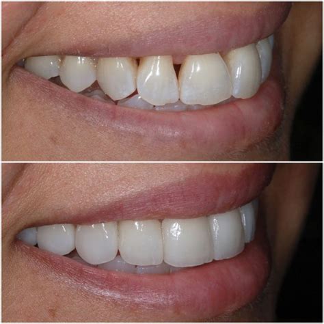 veneers near me before and after - Teofila Arredondo