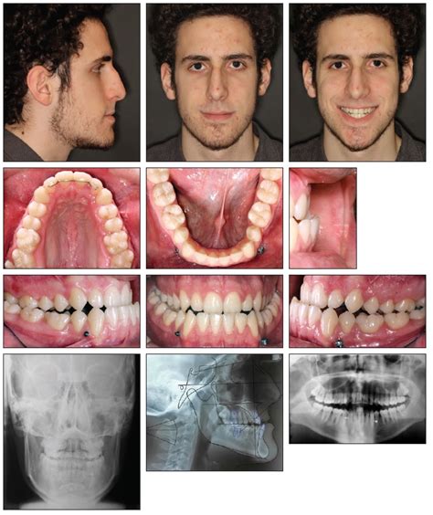 Tandem Skeletal Expander and MAPA Protocol for Palatal Expansion in ...