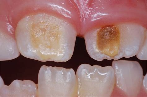 Enamel Hypoplasia