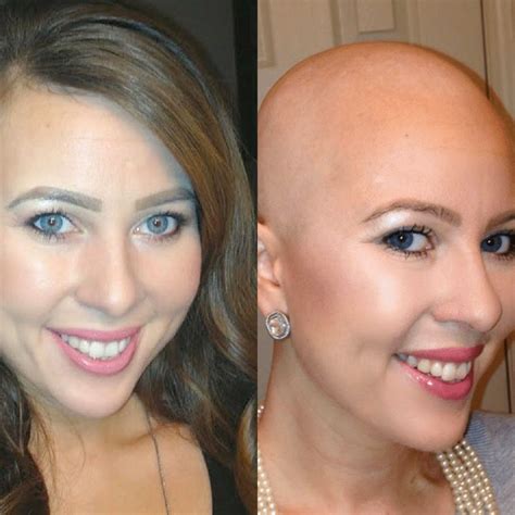 Cancer Hair Loss Support | CancerPal