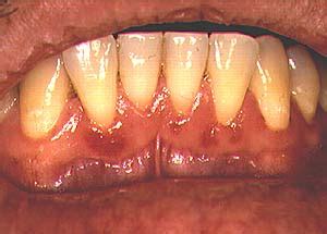 Linear Gingival Erythema