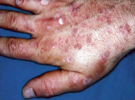 Epidermodysplasia verruciformis associated with isolated IgM deficiency ...