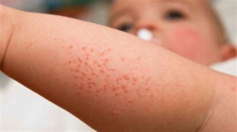 Heat Rash Causes Symptoms Treatments Heat Rash Heat Rash Causes - Riset