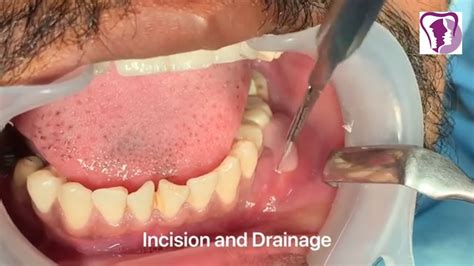 Incision and Drainage of Tooth Abscess Draining Pus - Dental Clinic