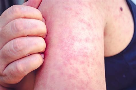 What Causes a Maculopapular Rash? - Facty Health