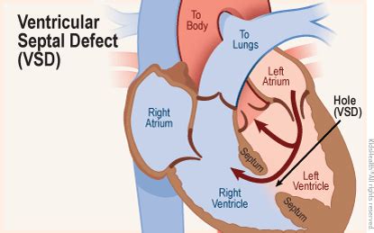 Ventricular Septal Defect Types