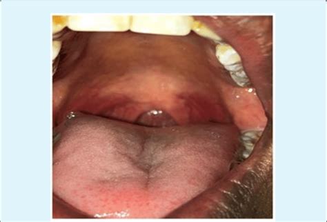 Oral cavity, teeth with absent uvula. | Download Scientific Diagram