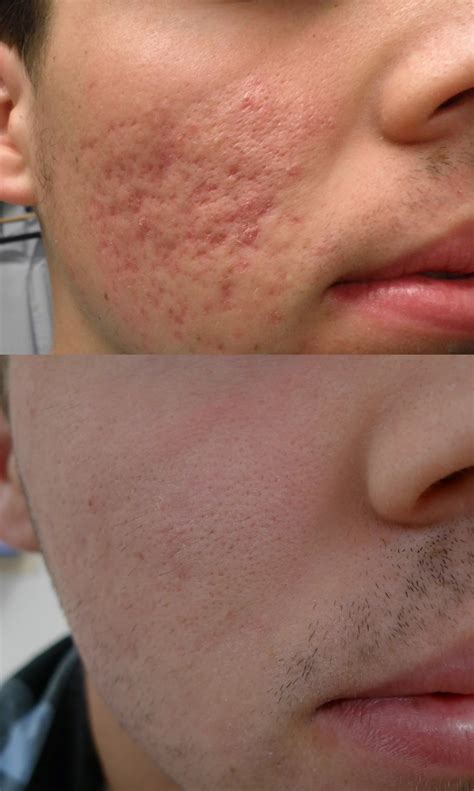 CO2 Laser Resurfacing For Acne Scars - Cutis Dermatology