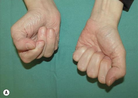 Step-cut fractional lengthening of flexor tendons and flexor digitorum ...