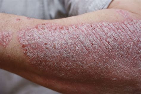 Psoriasis Treatment in Houston - Houston Laser Skin Center