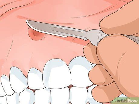 How to Get Rid of a Gum Boil: 10 Steps (with Pictures) - wikiHow