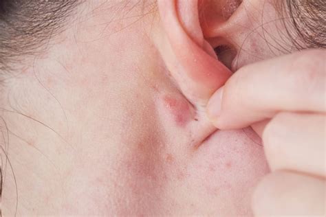 Lumps Behind the Ear: 6 Causes & When to See a Doctor - Tua Saúde