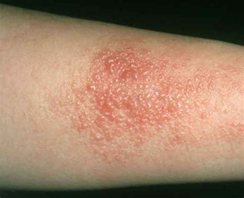 Contact Dermatitis Treatment Islamabad - 051 2211113 - Dr. Shumaila Khan