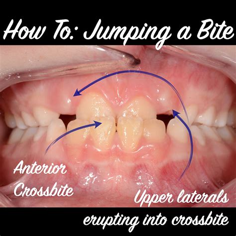 Anterior Crossbite Correction in Young Patients