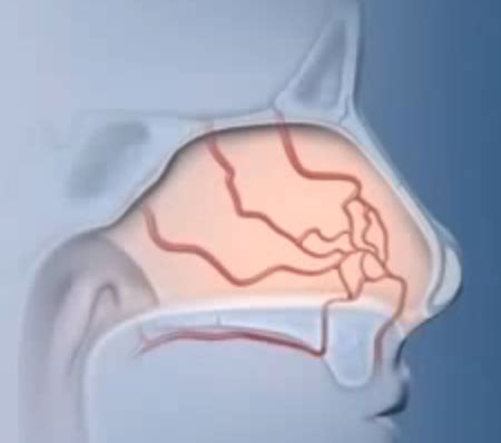 Dry Nasal Passages - causes and treatment