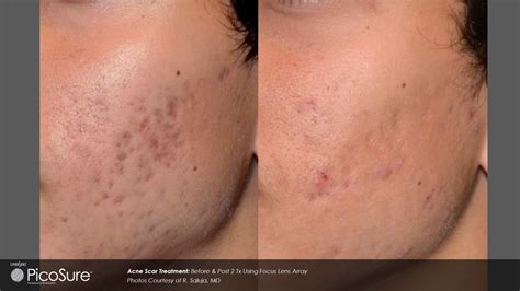 Acne Scar Treatment Sydney | Large Pores Treatment