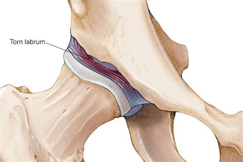 Hip acetabular/labral tear