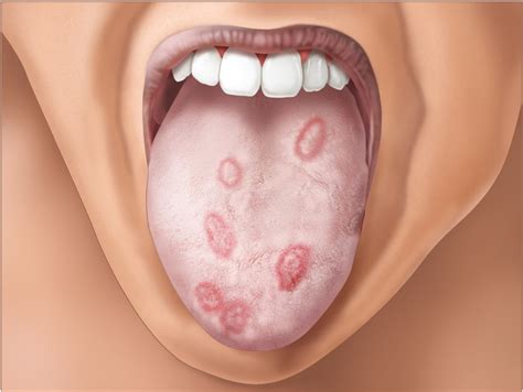 What Does Syphilis Look Like On Lips | Lipstutorial.org