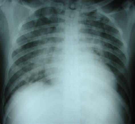 Chest X-ray supine view with pulmonary congestion